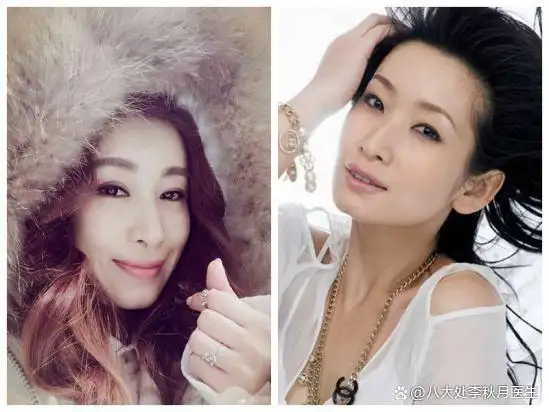 秦海璐因产后倒睫割了双眼皮,为啥倒睫还要割双眼皮呢?