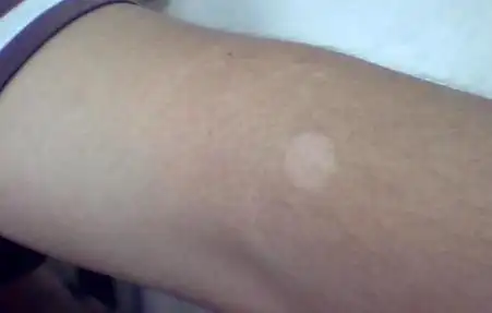 男性 手臂白癜风 36岁