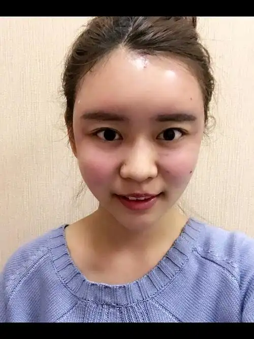 我是做的自体脂肪填充全脸,宝宝们可以看照片,手术前_圈子-新氧美容