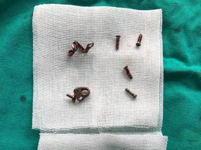 手术的这些问题,只要是要做下颌角手术,就都需要打钛锭钛板来固定的