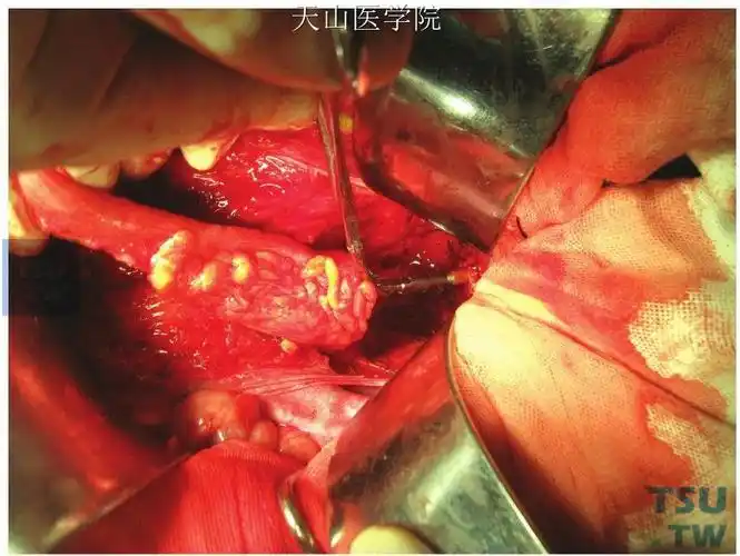 吻合器抵钉座置入近侧乙状结肠断端荷包结扎