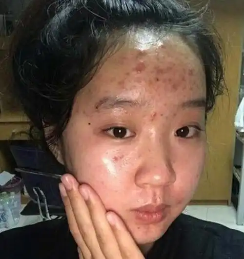 男生会喜欢满脸痘痘的女生吗? - 紫河马网