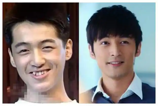 明星矫正牙齿前