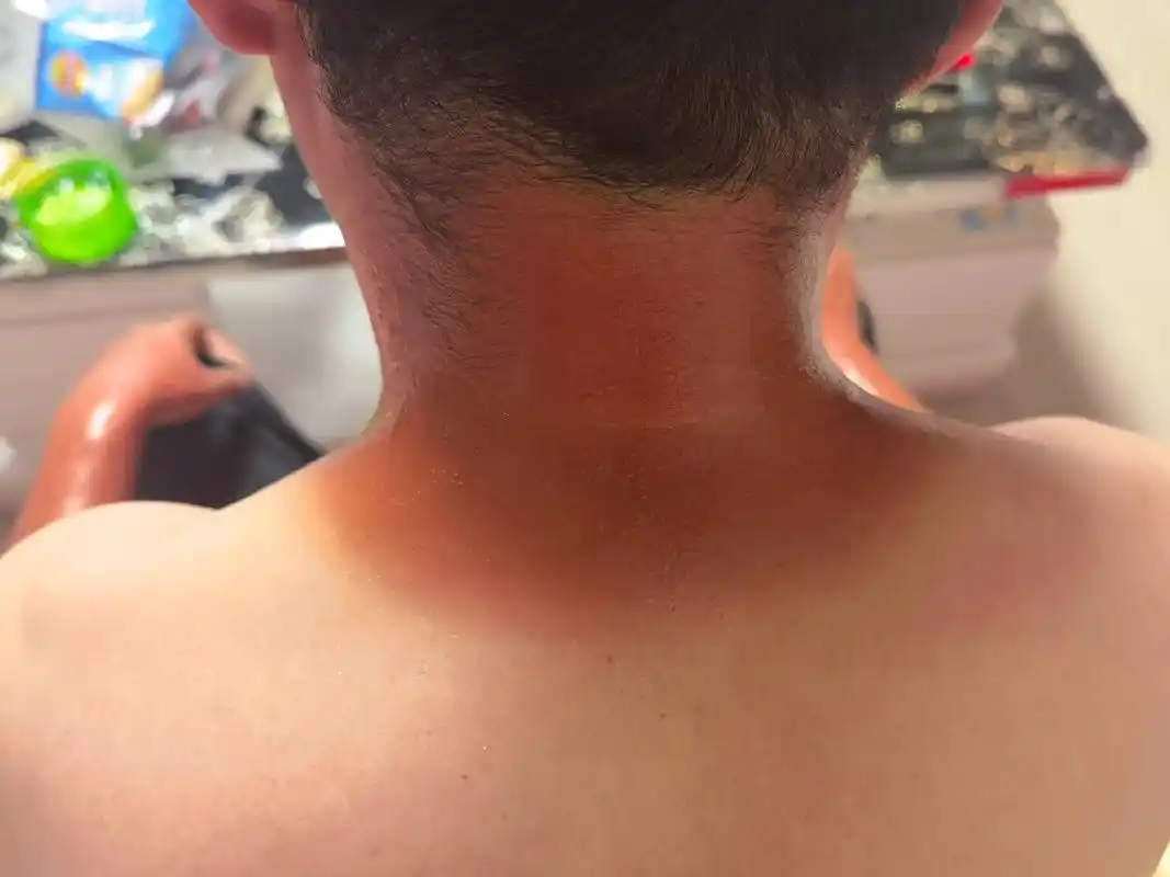 能被一点太阳晒黑皮肤的不是真的白是真的黑