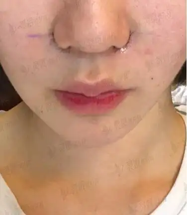 甩掉大鼻头鼻翼缩小前后对比图分享术后30天get精致美鼻