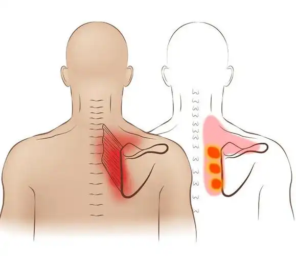 肩胛骨缝疼劝你不要再乱按了