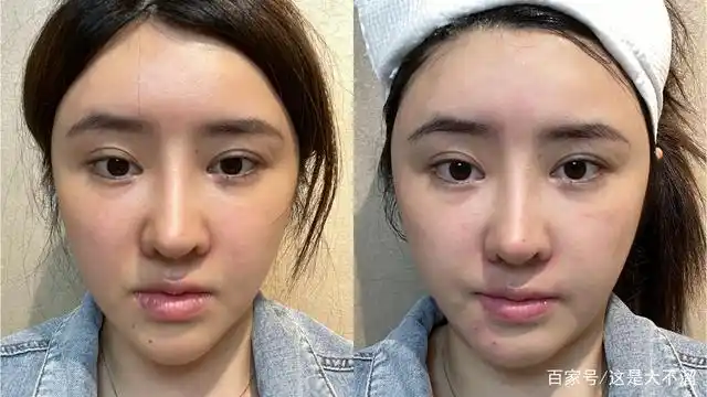 做完m22对比,我竟然真的变白了