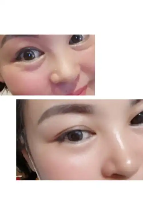 三天的效果!眼袋明显小了!泪沟痕明显消失了!值得所有小姐姐入手呦!