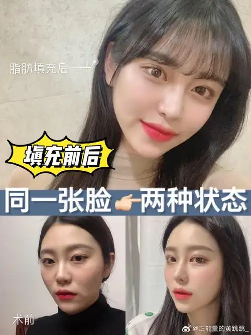 自体脂肪面部填充,前后判若两人!