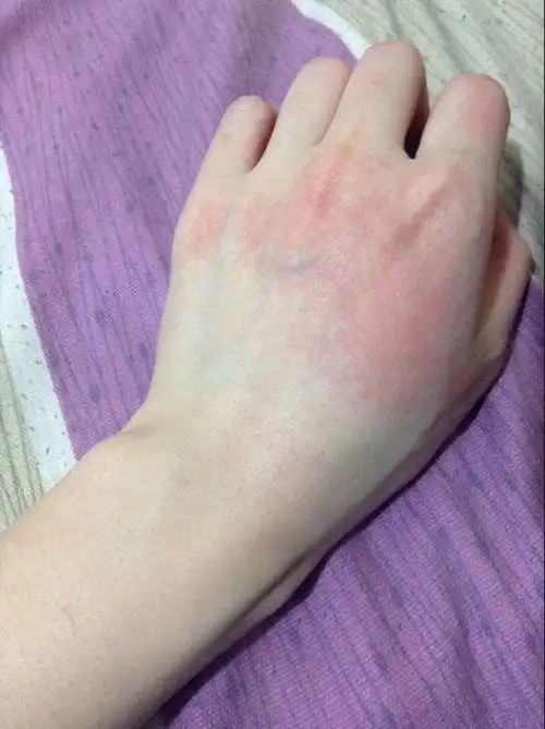 冬天,不晓得是风吹了还是冷水洗手,手背红一片,是什么原因