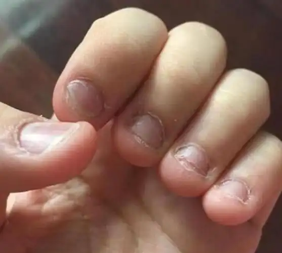 从小爱"咬指甲"的孩子,长大后会怎样?医生:逃不过两种结局