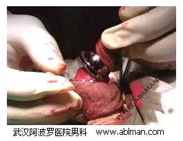 老年人包茎包皮环切手术过程直播(图) - 割包皮手术科普站