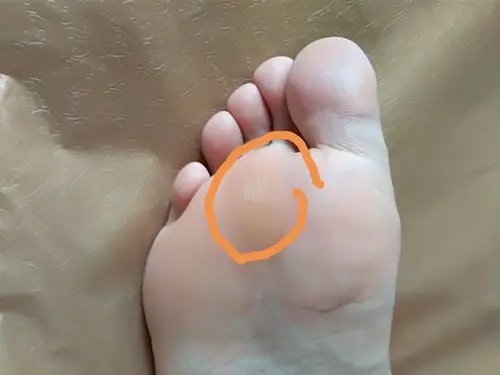 走路时脚前掌疼是为什么?