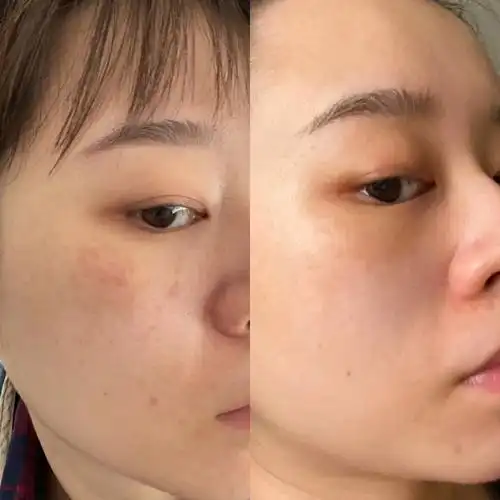 事实证明,甘草酸二钾被称为最天然的祛斑剂还真有他的道理,去起斑来他