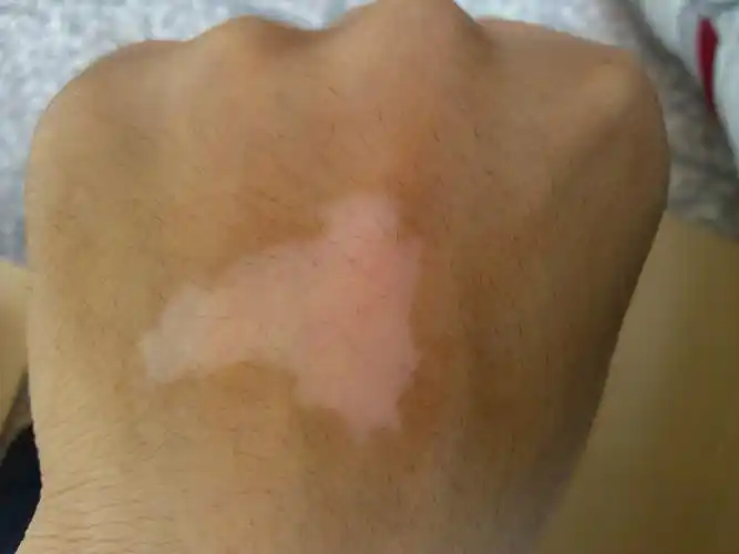 武汉治疗白癜风专科医院?怎么防止白癜风扩散