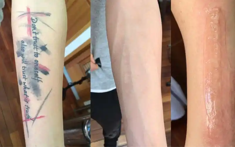 昆明洗彩色纹身小伙子手臂彩色清洗三次对比!