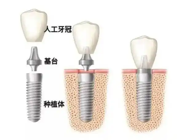种植牙(保姆级功课):一篇文章帮你快速找到种牙方案