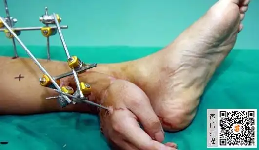 脚踝断手:脚踝断手25岁小伙不幸被机床截肢