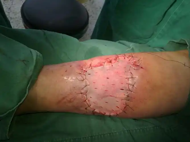 住院第7天创面清创后植皮情况.