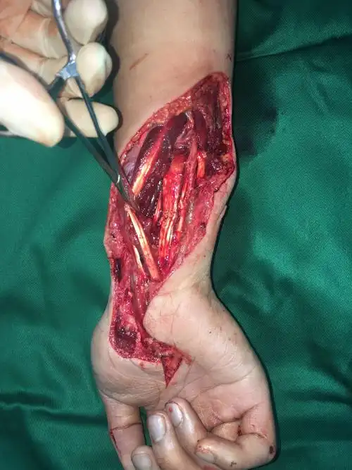 骨伤科 前臂切割伤手术1例