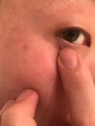 眼睛旁边长了一颗肉粒,不痛不痒,越来越大