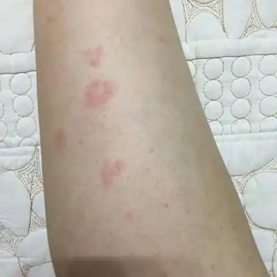 怀孕快四十天,腿上突然长一片一片的红斑,怎麼回事