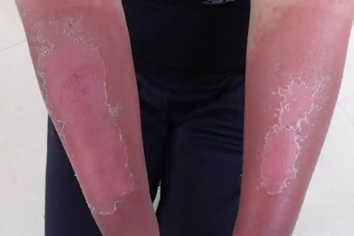 日光性皮炎手臂紫外线过敏图