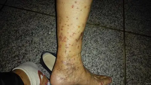 请大家帮忙看看我外婆小腿上长的是什么