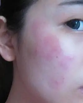 1,您好,脸部皮肤过敏的话有两种可能,那就是敏感性肌肤,还有就是对某