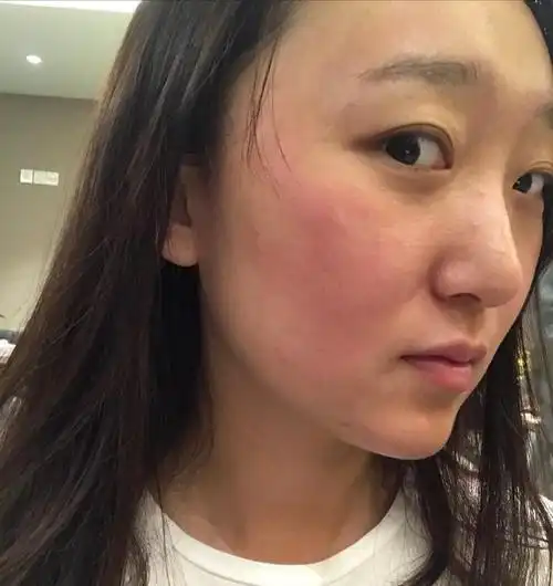 皮肤白皙的女生,脸部多半会有这些缺点,看完你还羡慕吗?