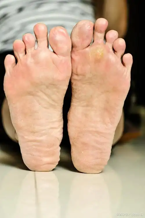 脚特爱出汗咋回事