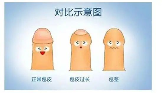 包皮过长/包茎科普_包茎_包茎介绍 - 好大夫在线