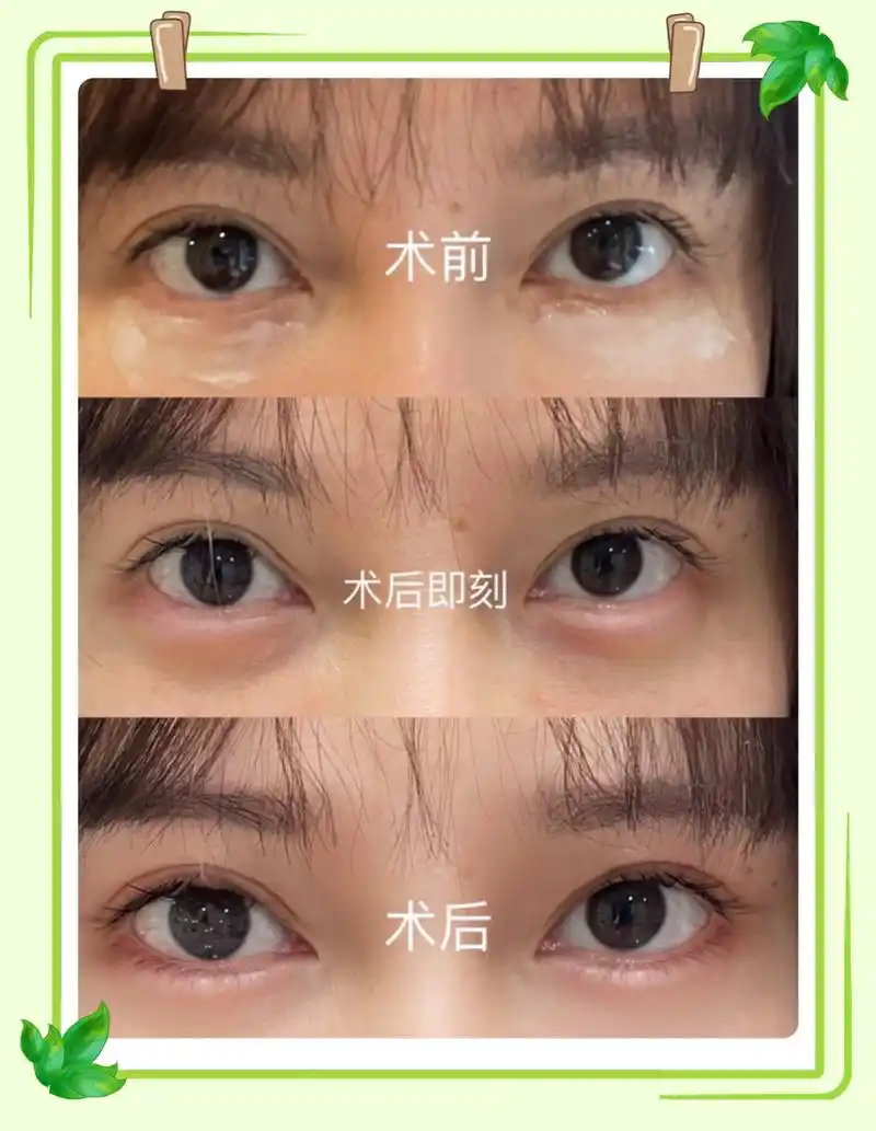 玻尿酸填充卧蚕