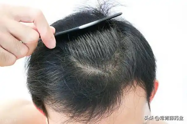 最近脱发严重怎么知道头发变少了 你的头发逐渐在变细软(3)