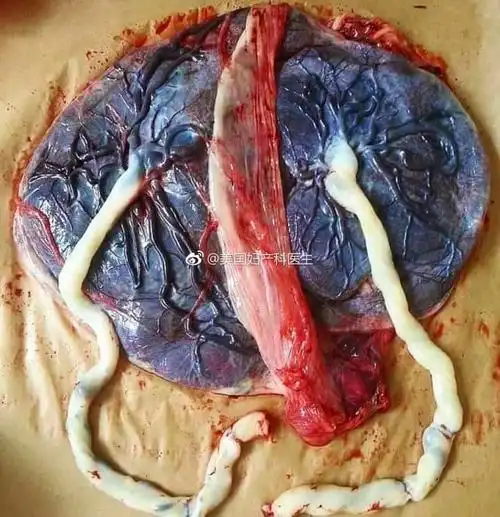 一个漂亮的双胞胎胎盘这里可以看到一个. 来自美国妇产科医生 - 微博