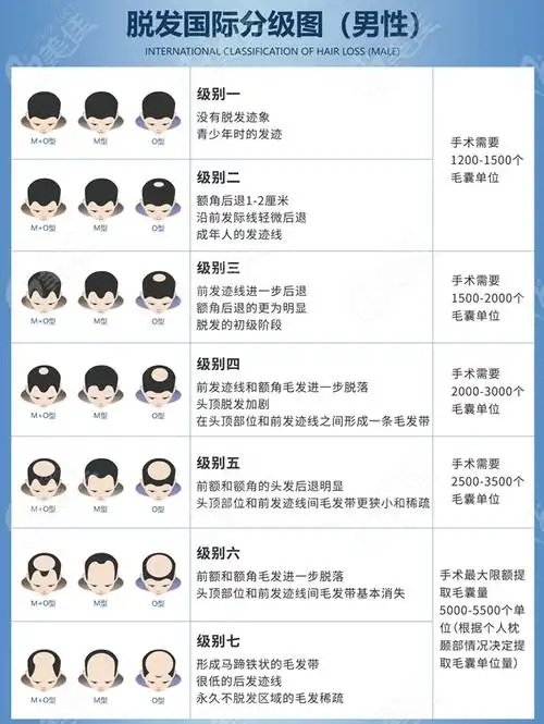 男性脱发等级示意图