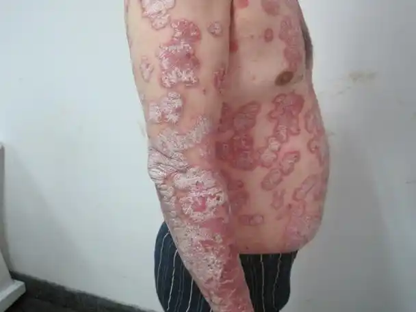 很担心 得了牛皮癣会影响生育吗_重庆治皮肤病医院