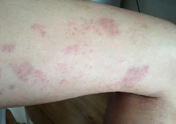 头皮牛皮肤癣的症状图片_银屑病求医网