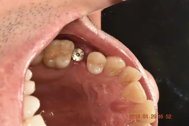 种植牙病理分享