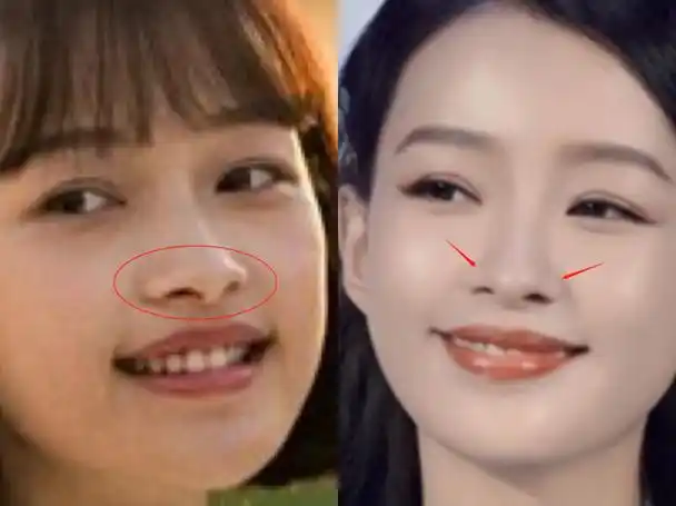 为什么鼻子整形后笑起来那么假