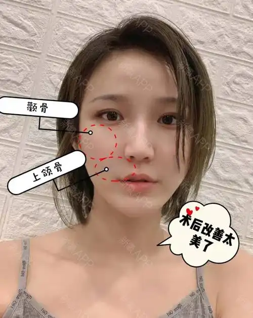 垫高鼻基底也解决不了?