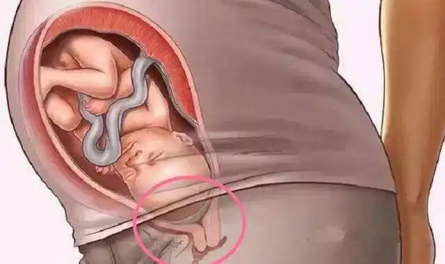 怀孕36周时孕肚开始渐渐向下沉,这种向下沉的感觉就是胎儿渐渐入盆