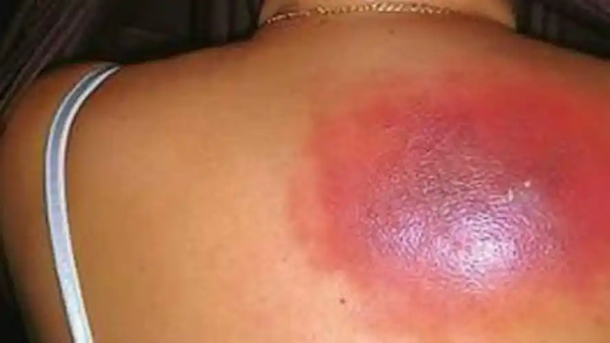 背上长了这种疮,一不小心就会痛死,到底是什么?