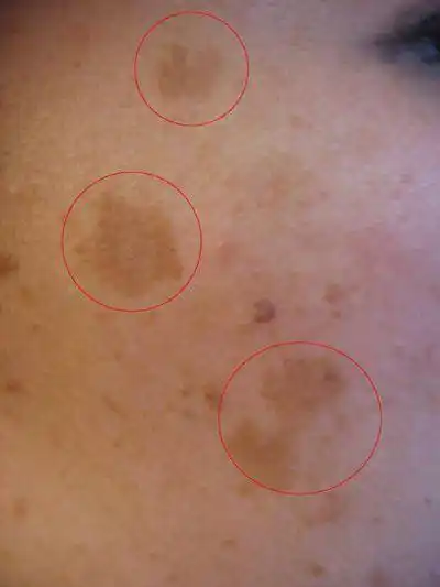 年轻人为什么长老年斑面部七种斑的图片