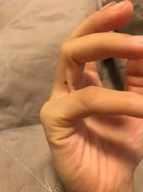 右手无名指有颗痣,在靠近小拇指那一侧,从小都有,这个痣代表什么?