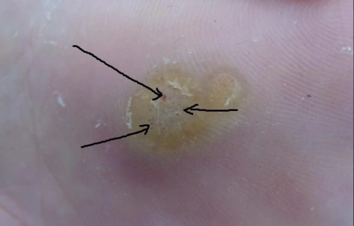 图解跖疣鸡眼和胼胝三者区别