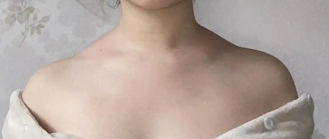 想问问这种肩颈问题是富贵包吗还是单纯的斜方肌厚或者是驼背问题吗