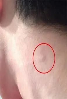 淋巴结肿大与淋巴癌的关系