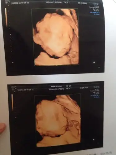 四维彩超有没有宝宝是侧脸睡的,我想再做一次