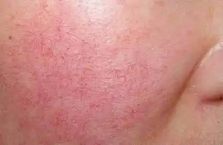 脸部过敏别担心,七个小方法助你有效恢复